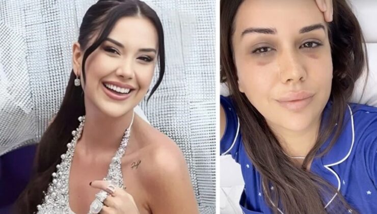 Dilan Polat’ın yüzündeki morlukların nedeni aşikâr oldu