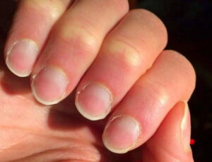 Tırnaklardaki sessiz ikaz: Hangi değişim hangi hastalığın habercisi?